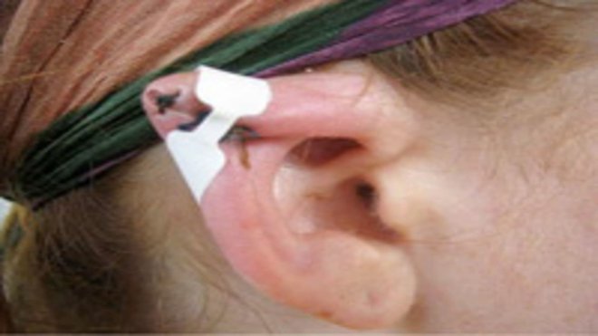 Dr. Igercje nam je povedala, da se na Kitajskem mnoge ženske lotevajo nevarne plastične operacije, da bi dosegle "vilinska ušesa". Foto: NYPOST
