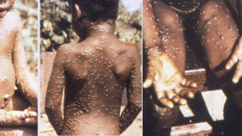 Fotografija: Bolezen prihaja iz Afrike, najpogosteje zbolevajo otroci.
