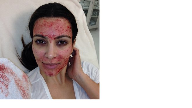 Kim Kardashian je leta 2013 po spletu strašila s posnetkom »vampire facial«, po postopku je njen obraz krvavel.
Foto Kim Kardashian/instagram
