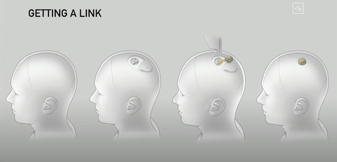Robot oziroma mini čip se implantira direktno v možgane. FOTO: Neuralink/AFP via Getty Images